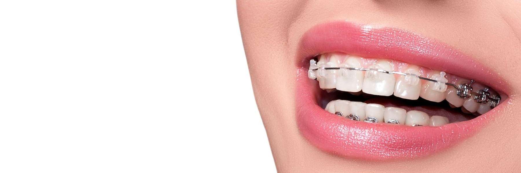 Patient smiling with braces for orthodontic treatment