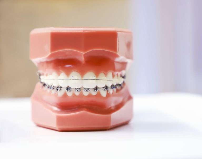Black Rock dentist's tooth model with braces