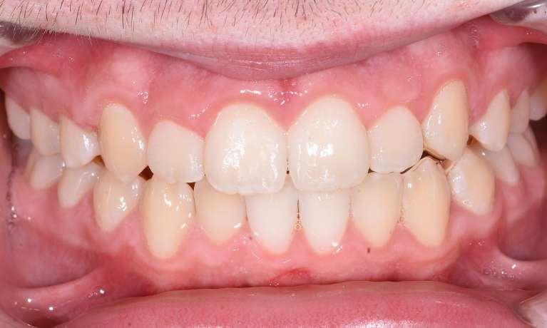 Black Rock Teeth Expansion
