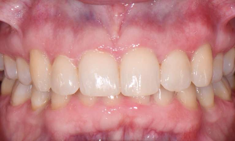 Invisalign-After-Image