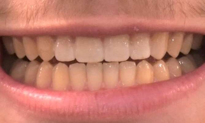 patient after Invisalign treatment at Bayside Smiles