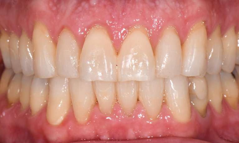 Orthodontic-Treatment-with-Invisalign-After-Image