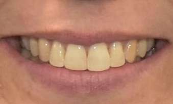 Invisalign-Success-Story-After-Image