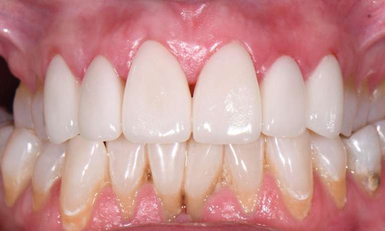 Veneers-Teeth-Whitening-After-Image
