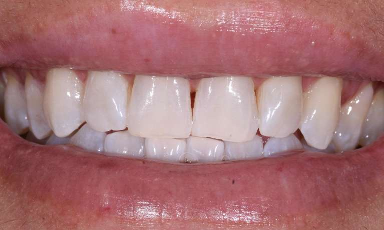Teeth-Whitening-After-Image