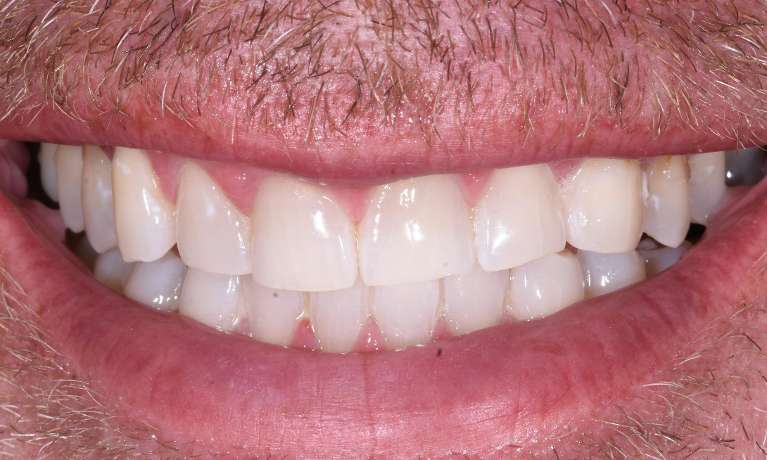 Teeth-Whitening-After-Image