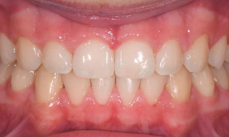 Results-of-Invisalign-After-Image