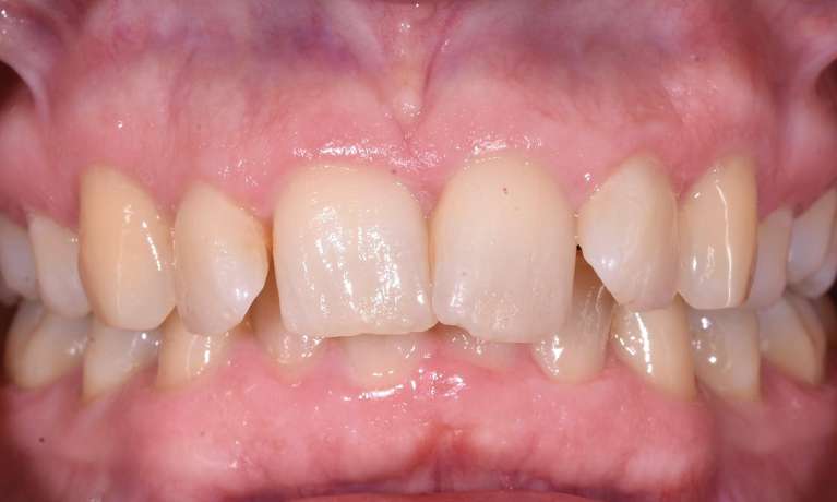 Invisalign-Before-Image