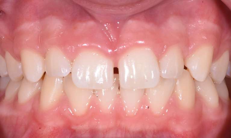 Results-of-Invisalign-Before-Image