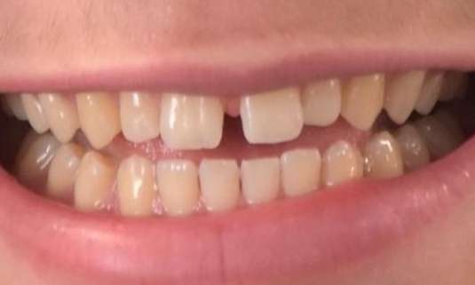 patient before Invisalign treatment at Bayside Smiles