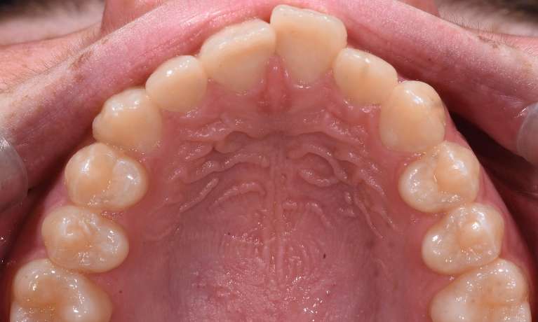 Alignment of top teeth before Invisalign in black rock