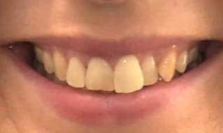 Invisalign-Success-Story-Before-Image