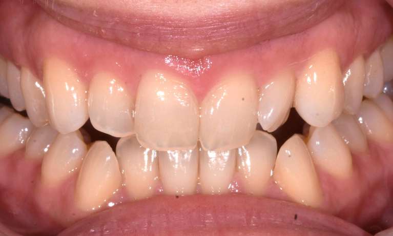 before photo for Invisalign treatment in black rock, vic