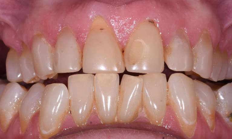 Veneers-Teeth-Whitening-Before-Image