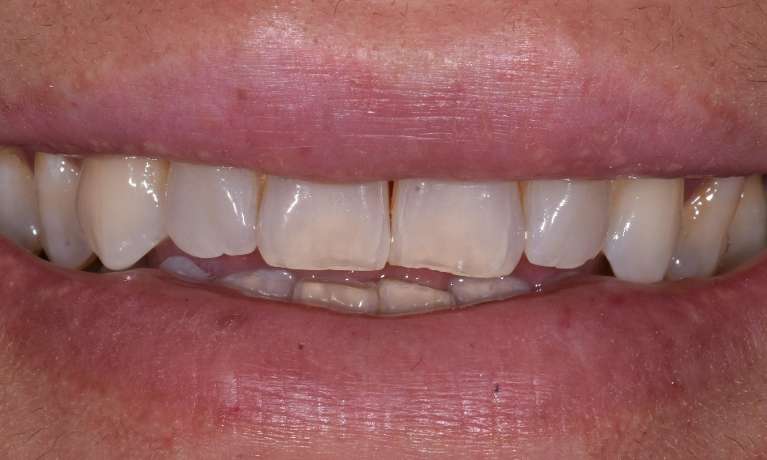 Teeth-Whitening-Before-Image
